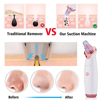 Deep Clean Pore Vacuum | 5 in 1 Blackhead Remover | Glowing Skin Tool